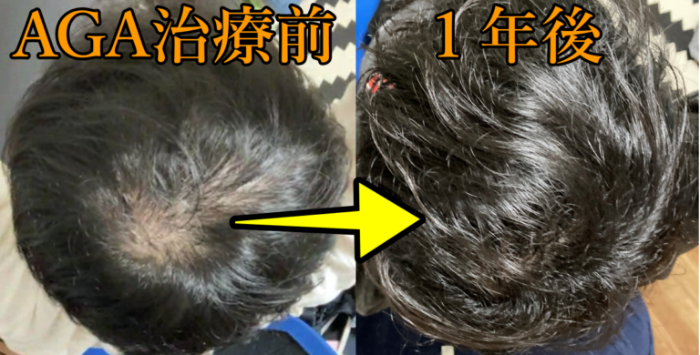芸能人が禿げないのはなぜか。 | aga治療ブログ